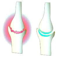 ازتروز ازتروز مفصل