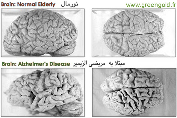 مریضی الزیمر مغزمریض الزیمر