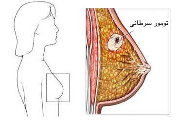 سرطان سینه