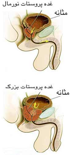 غده پروستات غده نورمال و غده بزرگ پروستات